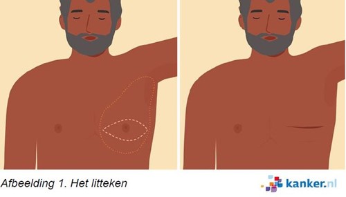 Illustratie van een litteken na borstamputatie bij een man