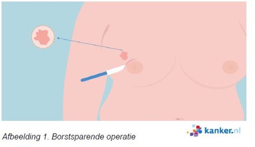Illustratie snijgebied borstsparende operatie