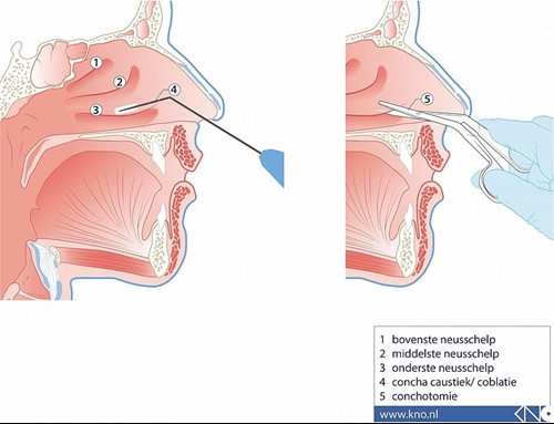 Canchacaustiek en conchrotomie