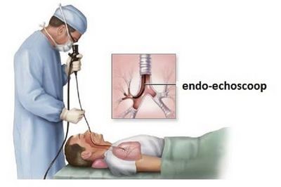 Echo endoscoop