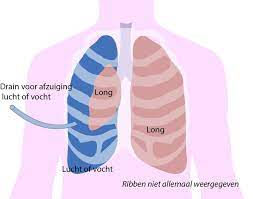 Pleurodese longen