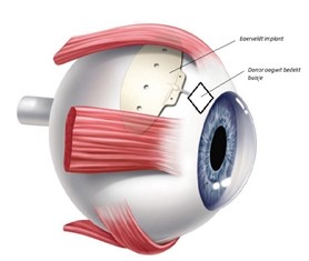 Illustratie van oog met Baerveldt implant