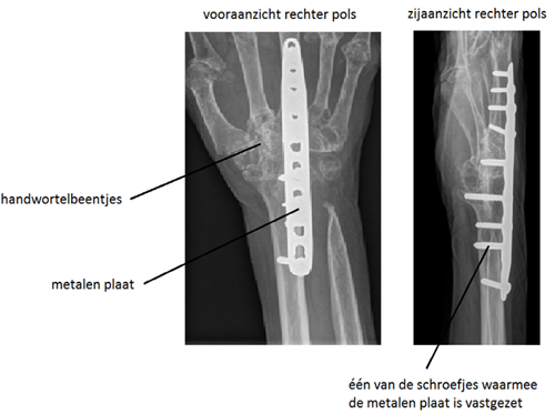 Röntgenfoto van de rechter pols na het vastzetten van het polsgewricht.