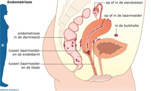 illustratie van endometriose