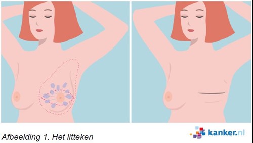 Litteken na een borsoperatie bij borstkanker