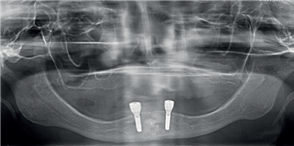 Implantaten op rontgenfoto