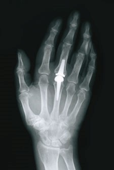Röntgenfoto van hand met protese