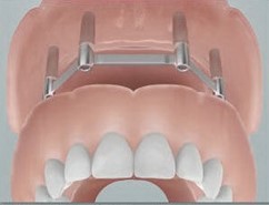illustratie van implantaten in de bovenkaak