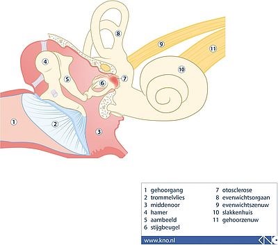 Otosclerose