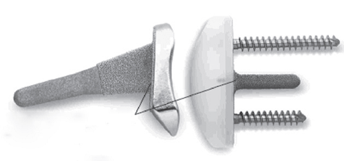 Polsprothese