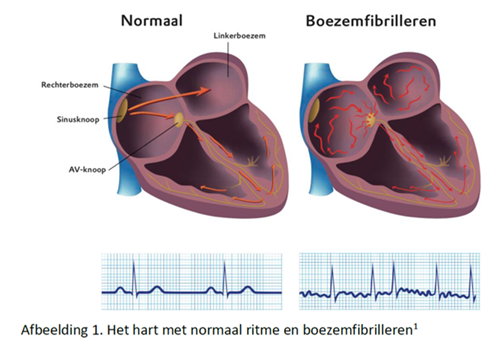 Voorbeeld boezemfibrilleren