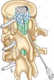 illustratie van een ruggenwervel waar een epidurale injectie in wordt gezet