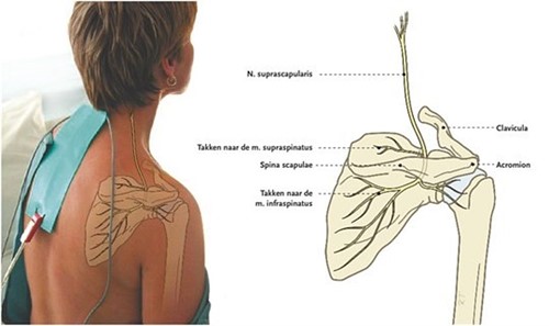 Parasiet ten tweede beoefenaar Blokkade van de nervus suprascapularis en nervus axillaris  (schouderklachten) - Rivas