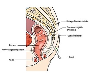 illustratie van een dwarsdoorsnede van het heilig been met een naald bij de ganglion impar