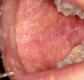 Wangslijmvlies met lichen planus