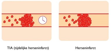 Voorbeeld TIA en herseninfarct