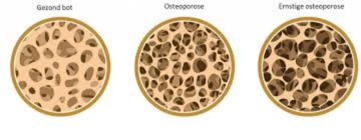Binnenkant gezond bot en bot met osteoporose