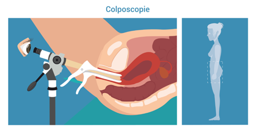 Afbeelding onderzoek Colposcopie