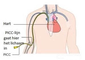Inbrengen PICC Lijn