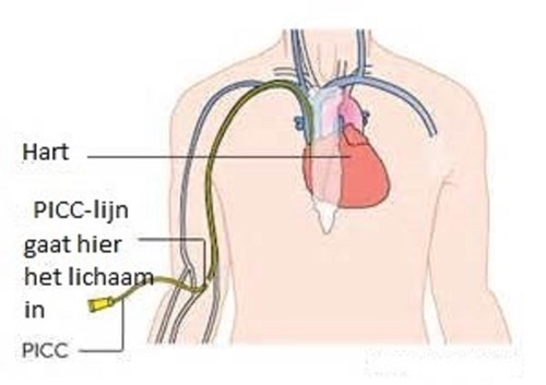 Inbrengen PICC Lijn