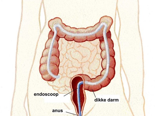 illustratie van de dikke darm met endoscoop erin