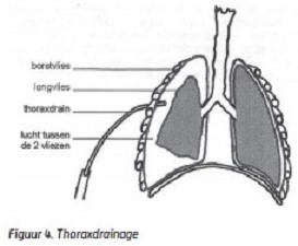 Thorax drain inbrengen 1