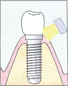 illustratie van tand met implantaat poetsen