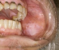 Leukoplakie in de mond