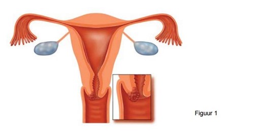 Illustratie van baarmoederhals en baarmoedermond